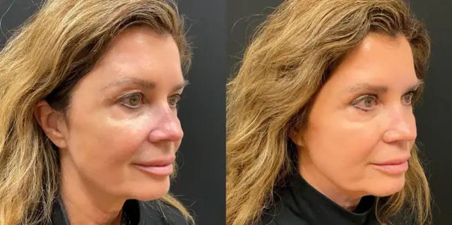 Blepharoplasty result at My Plastic Surgery Group in Carmel, IN