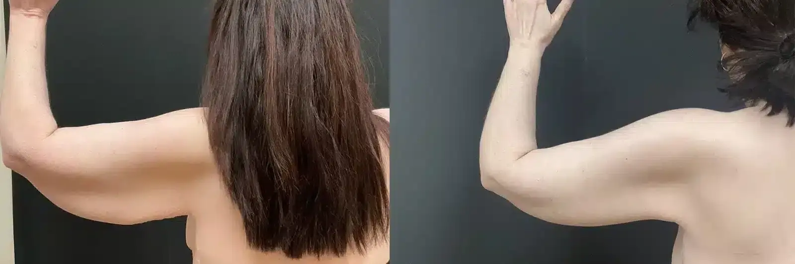 My Plastic Surgery Group arm lift result — Carmel, IN