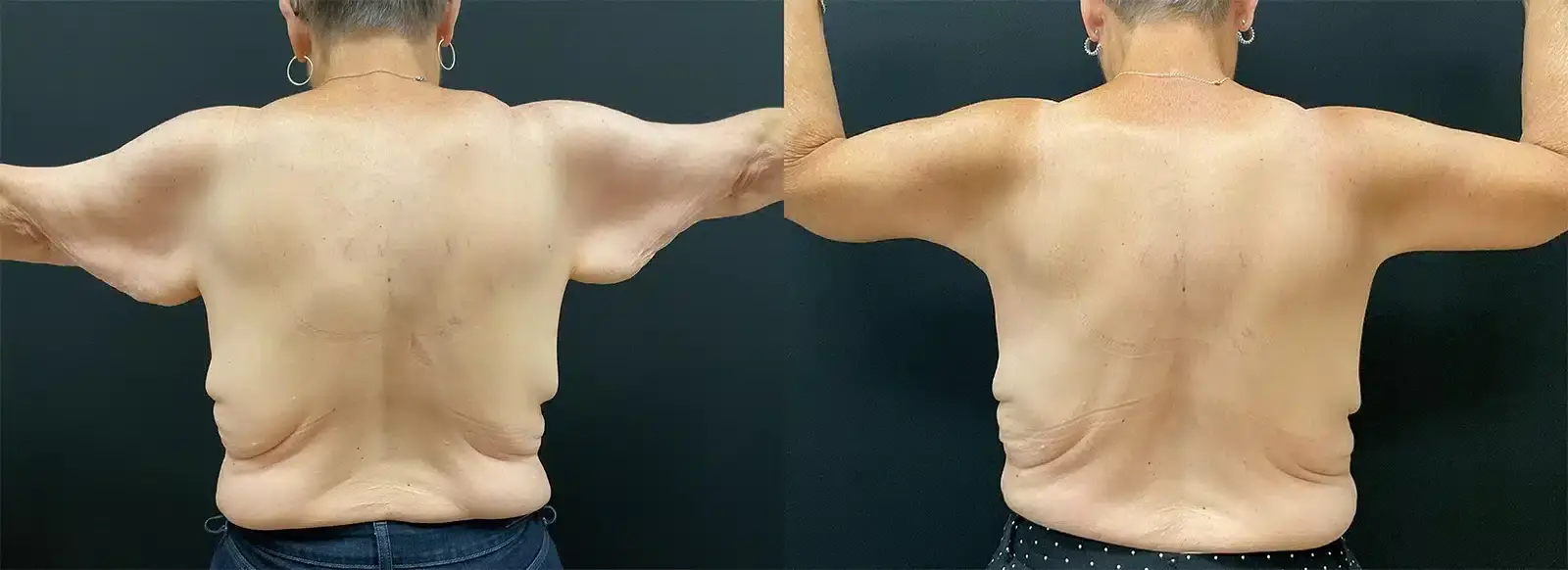 My Plastic Surgery Group arm lift result — Carmel, IN