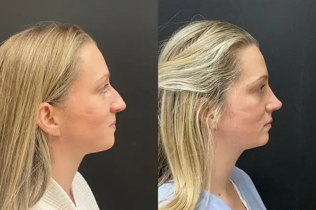 Rhinoplasty result at My Plastic Surgery Group in Carmel, IN