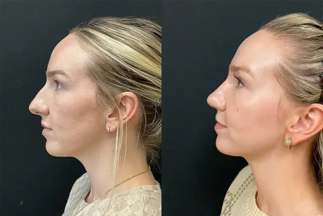 Rhinoplasty result at My Plastic Surgery Group in Carmel, IN