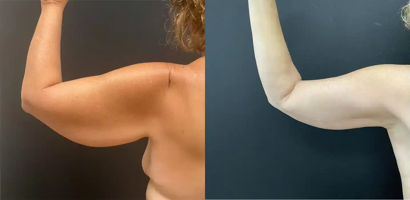 My Plastic Surgery Group arm lift result — Carmel, IN
