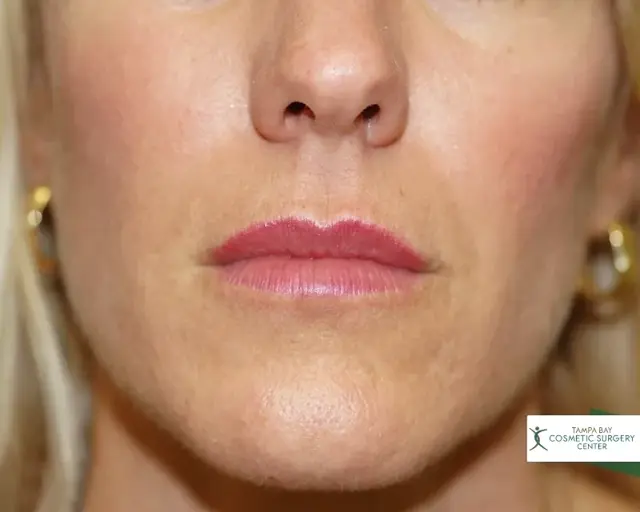 Lip Filler before at Tampa Bay Cosmetic Surgery Center in St. Petersburg, FL