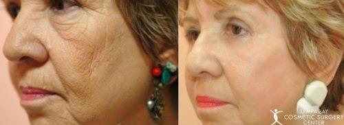 Laser Skin Resurfacing result at Tampa Bay Cosmetic Surgery Center in St. Petersburg, FL