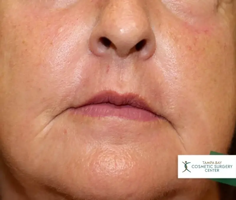 Tampa Bay Cosmetic Surgery Center chemical peel after — St. Petersburg, FL
