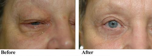 Neck Lift result at Tampa Bay Cosmetic Surgery Center in St. Petersburg, FL
