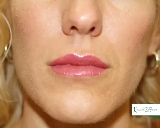 Lip Filler after at Tampa Bay Cosmetic Surgery Center in St. Petersburg, FL