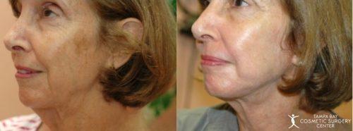 Laser Skin Resurfacing result at Tampa Bay Cosmetic Surgery Center in St. Petersburg, FL