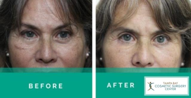 Neck Lift result at Tampa Bay Cosmetic Surgery Center in St. Petersburg, FL