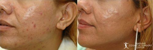 Microneedling result at Tampa Bay Cosmetic Surgery Center in St. Petersburg, FL