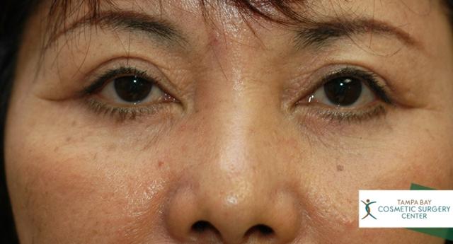 Neck Lift after at Tampa Bay Cosmetic Surgery Center in St. Petersburg, FL