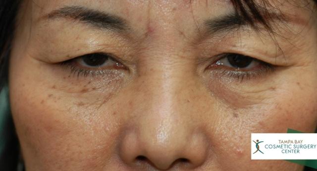 Neck Lift before at Tampa Bay Cosmetic Surgery Center in St. Petersburg, FL