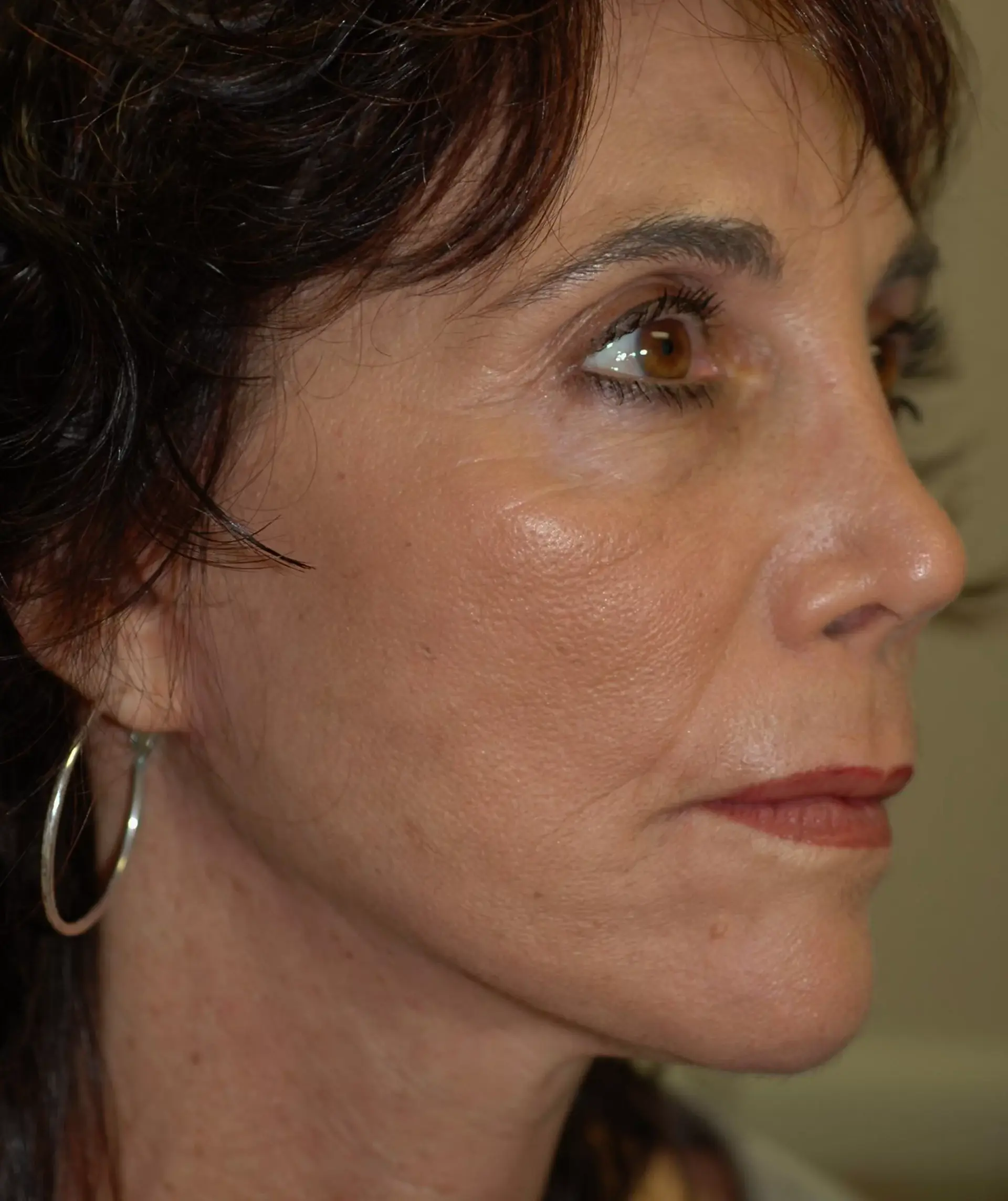 Tampa Bay Cosmetic Surgery Center chemical peel after — St. Petersburg, FL
