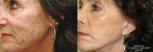 Chemical Peel result at Tampa Bay Cosmetic Surgery Center in St. Petersburg, FL