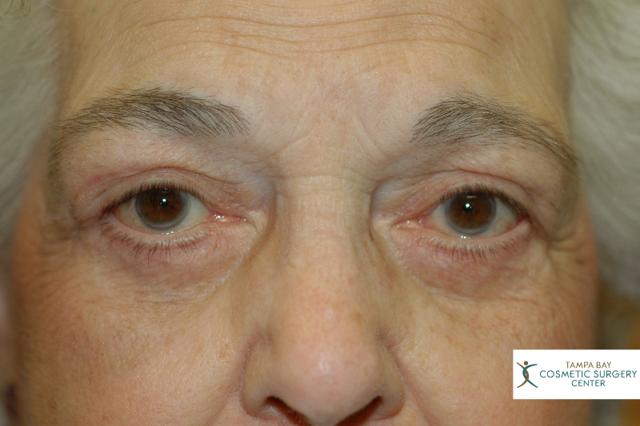 Blepharoplasty after at Tampa Bay Cosmetic Surgery Center in St. Petersburg, FL
