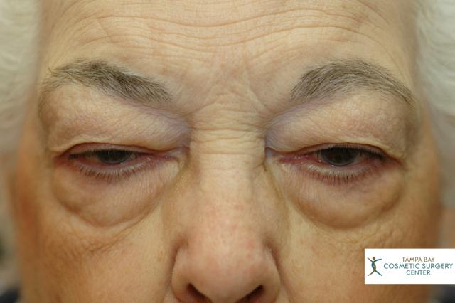 Blepharoplasty before at Tampa Bay Cosmetic Surgery Center in St. Petersburg, FL