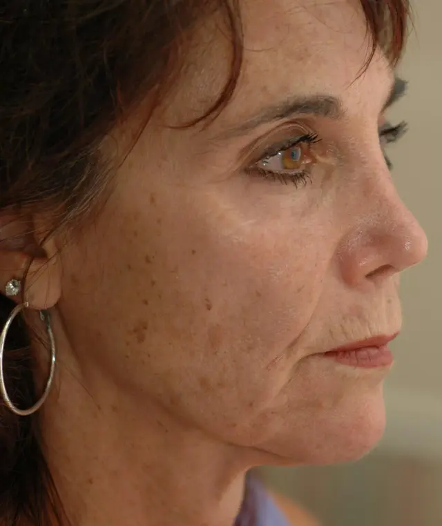 Chemical Peel before at Tampa Bay Cosmetic Surgery Center in St. Petersburg, FL
