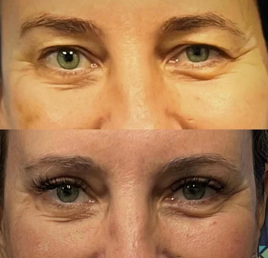 Kapil Saigal, MD eyelid lift result — Winter Park, FL