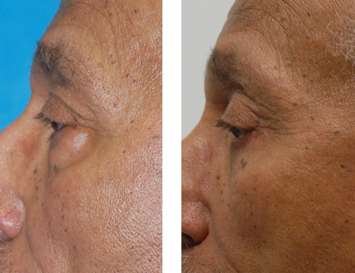 Kapil Saigal, MD eyelid lift result — Winter Park, FL