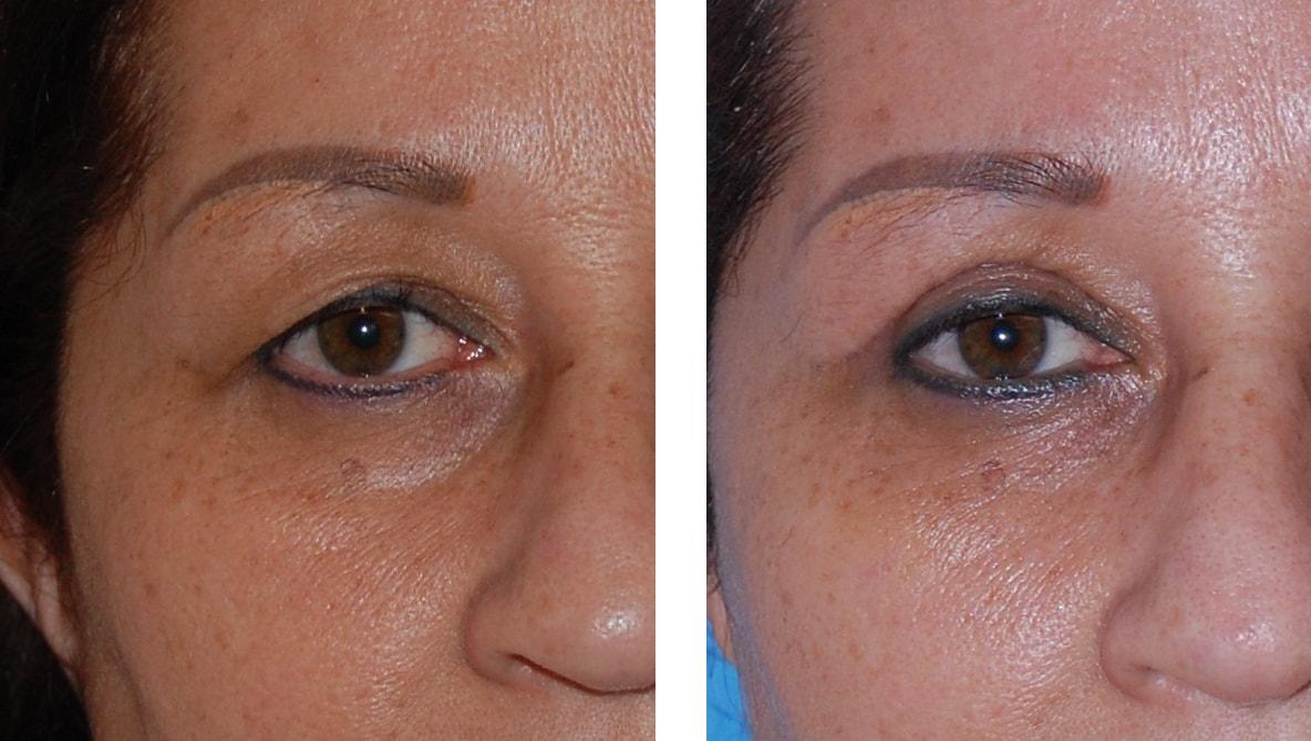 Kapil Saigal, MD eyelid lift result — Winter Park, FL