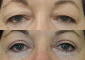 Tailor Made Looks Institute of Plastic Surgery and MedSpa eyelid lift result — Atlanta, GA