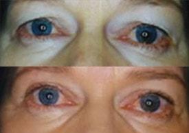 Tailor Made Looks Institute of Plastic Surgery and MedSpa eyelid lift result — Atlanta, GA