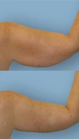Arm Lift result at Tailor Made Looks Institute of Plastic Surgery and MedSpa in Atlanta, GA