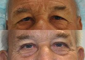 Tailor Made Looks Institute of Plastic Surgery and MedSpa eyelid lift result — Atlanta, GA