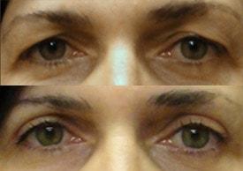Tailor Made Looks Institute of Plastic Surgery and MedSpa eyelid lift result — Atlanta, GA