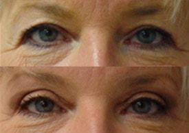 Tailor Made Looks Institute of Plastic Surgery and MedSpa eyelid lift result — Atlanta, GA