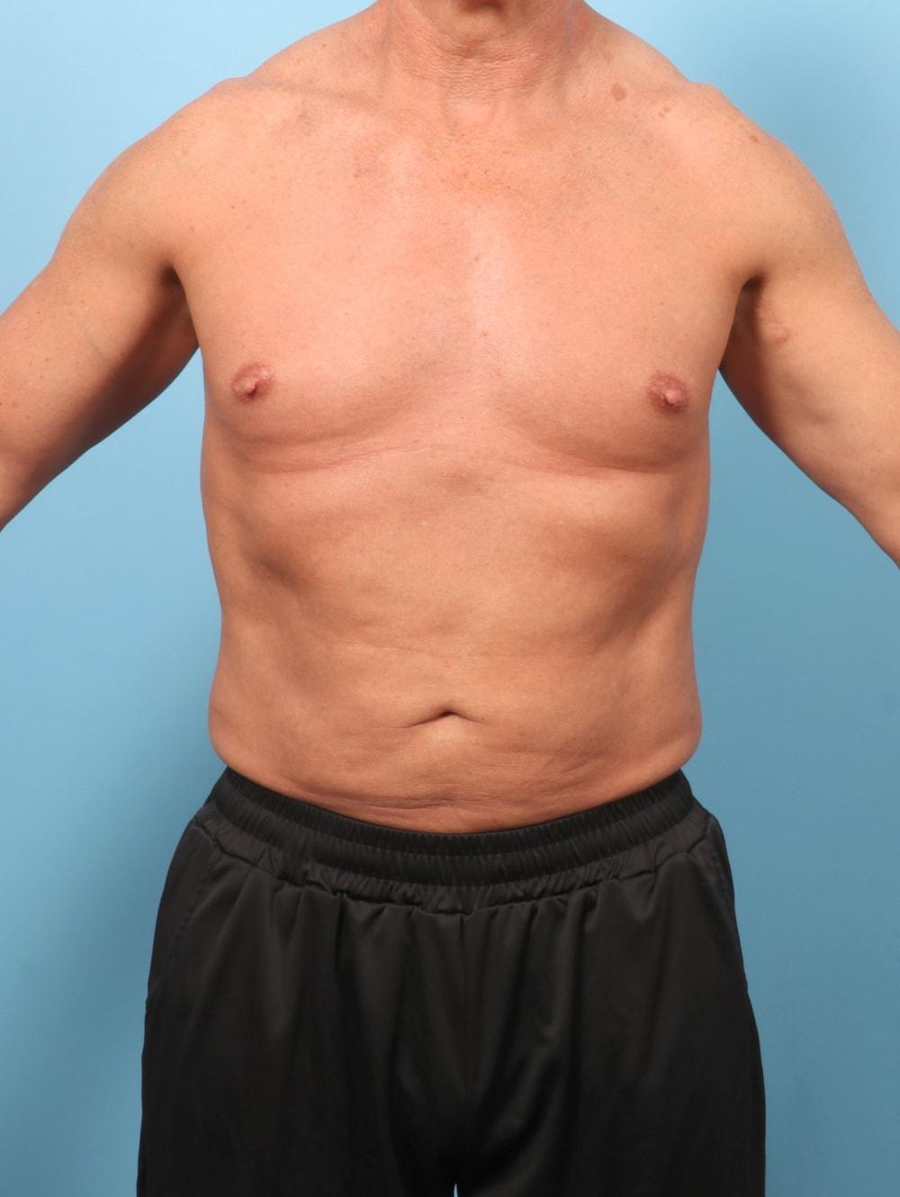 Drew Davis, MD liposuction after — Folsom, CA