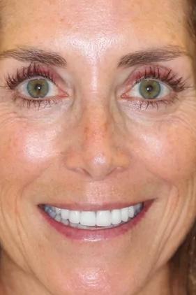 Almeida & Bell Dental veneers after — Denver, CO