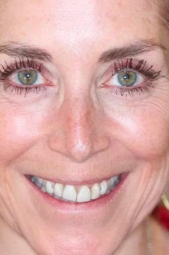 Dental Veneers before at Almeida & Bell Dental in Denver, CO