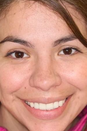 Almeida & Bell Dental veneers after — Denver, CO