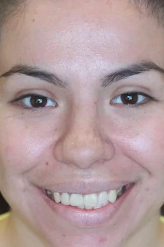 Dental Veneers before at Almeida & Bell Dental in Denver, CO