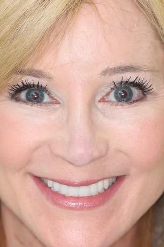 Almeida & Bell Dental veneers after — Denver, CO