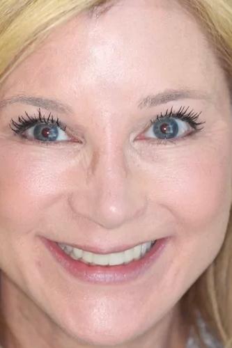 Invisalign before at Almeida & Bell Dental in Denver, CO