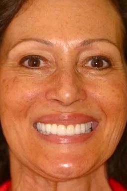 Almeida & Bell Dental veneers after — Denver, CO