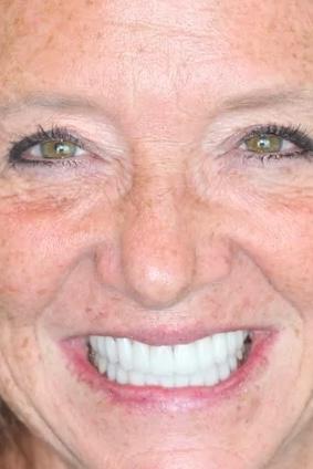 Almeida & Bell Dental veneers after — Denver, CO