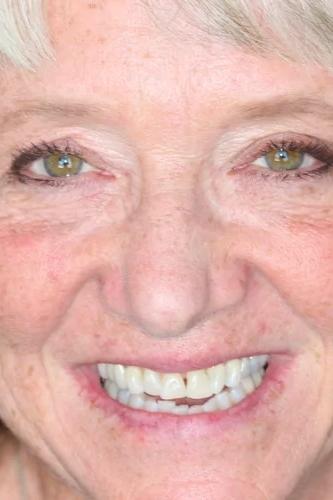 Dental Veneers before at Almeida & Bell Dental in Denver, CO