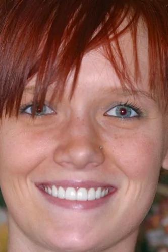 Almeida & Bell Dental veneers after — Denver, CO