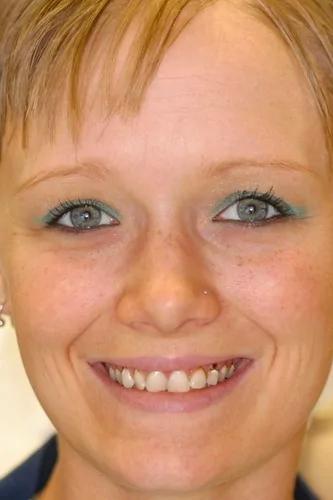 Invisalign before at Almeida & Bell Dental in Denver, CO
