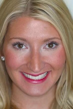 Almeida & Bell Dental veneers after — Denver, CO
