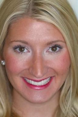Almeida & Bell Dental dental veneers result