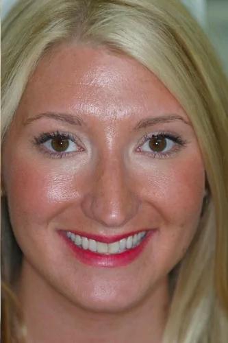 Invisalign before at Almeida & Bell Dental in Denver, CO