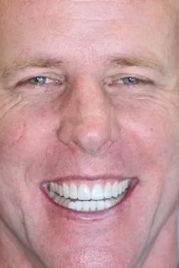 Almeida & Bell Dental veneers after — Denver, CO