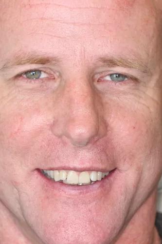 Dental Veneers before at Almeida & Bell Dental in Denver, CO