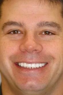 Almeida & Bell Dental veneers after — Denver, CO