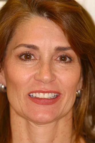 Dental Veneers before at Almeida & Bell Dental in Denver, CO