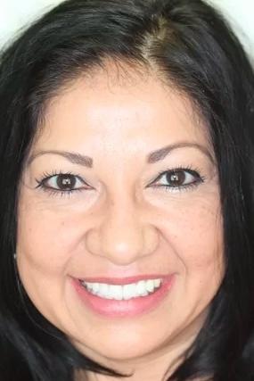 Almeida & Bell Dental veneers after — Denver, CO